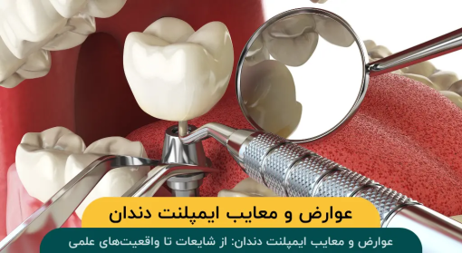 عوارض-معایب-ایمپلنت-دندان